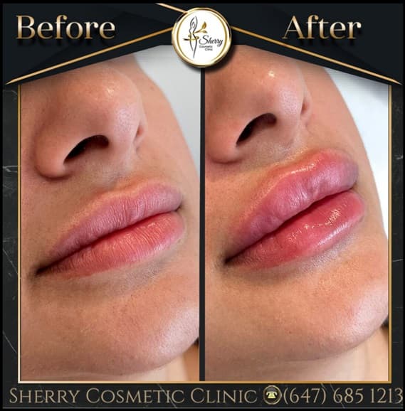 Revolutionizing Skincare: The Role of Fillers in Sherry Cosmetics