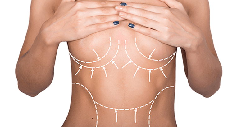 Body sculpting consultation markings