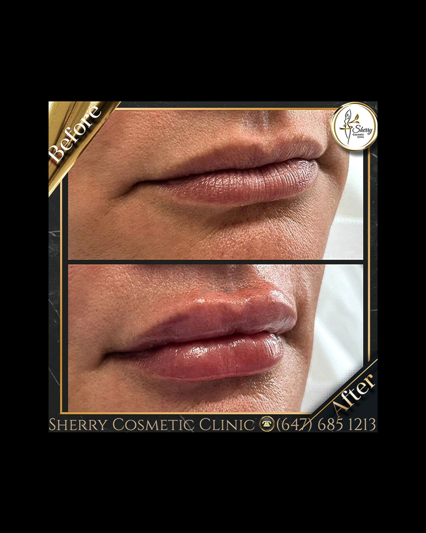 Enhance Your Beauty with Lip Fillers at Sherry Cosmetic
