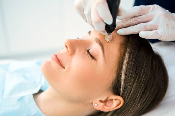 Dermapen skin needling
